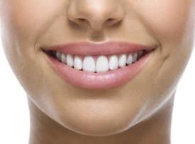 person smiling with veneers image